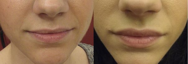 anti-aging-studio-hijaluron-usta